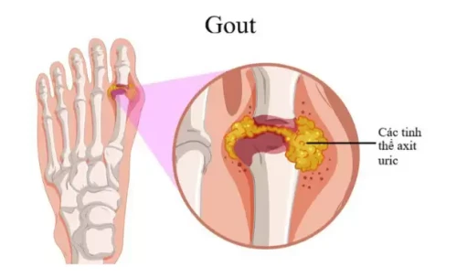 Bệnh Gout: Biểu hiện, Nguyên Nhân và Cách Phòng Tránh Hiệu Quả